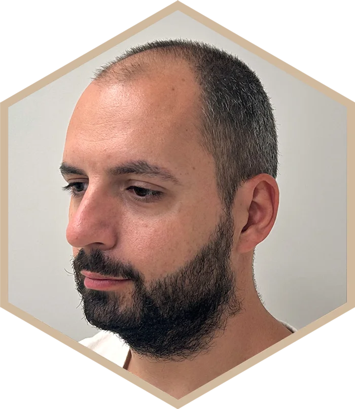 hajbeultetes-a-janos-elotte-1 Hair transplantation