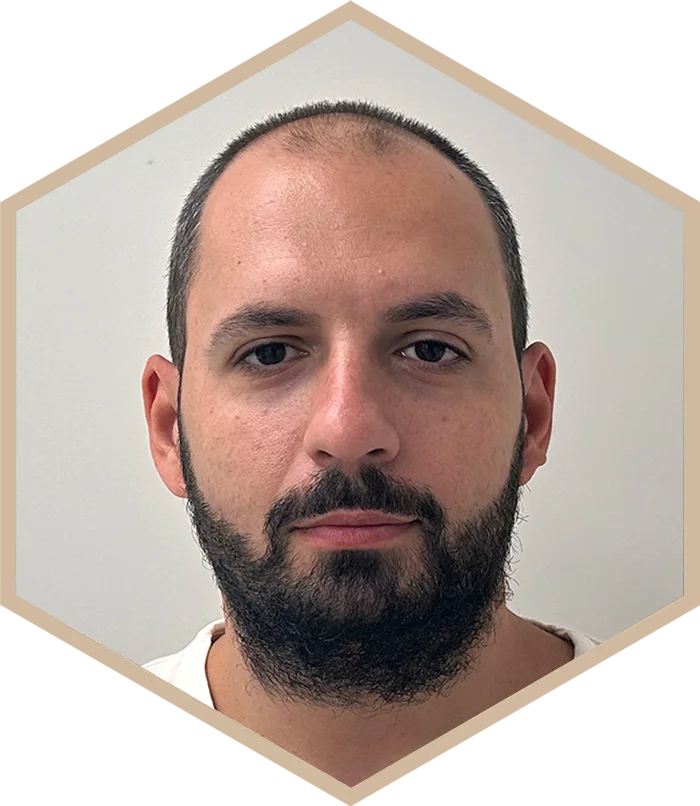 hajbeultetes-a-janos-elotte-2 Hair transplantation