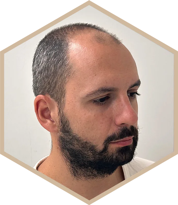 hajbeultetes-a-janos-elotte-3 Hair transplantation