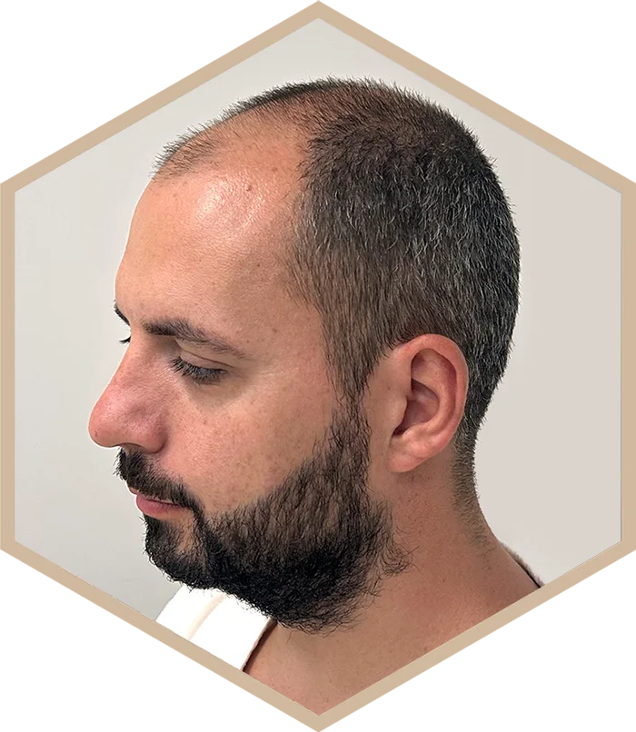 hajbeultetes-a-janos-elotte-4 Hair transplantation