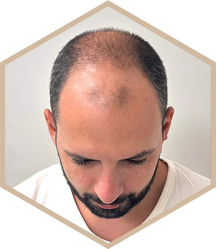hajbeultetes-a-janos-elotte-5 Hair transplantation