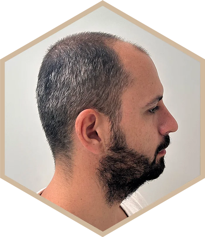 hajbeultetes-a-janos-elotte-6 Hair transplantation
