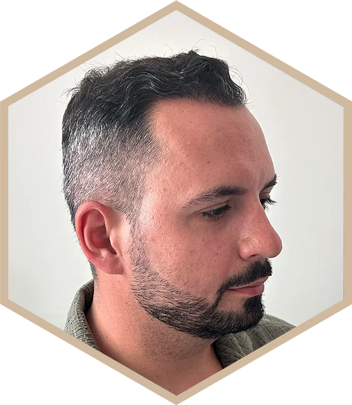 hajbeultetes-a-janos-utana-3 Hair transplantation
