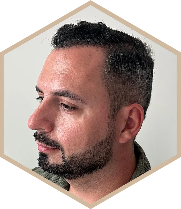 hajbeultetes-a-janos-utana-4 Hair transplantation