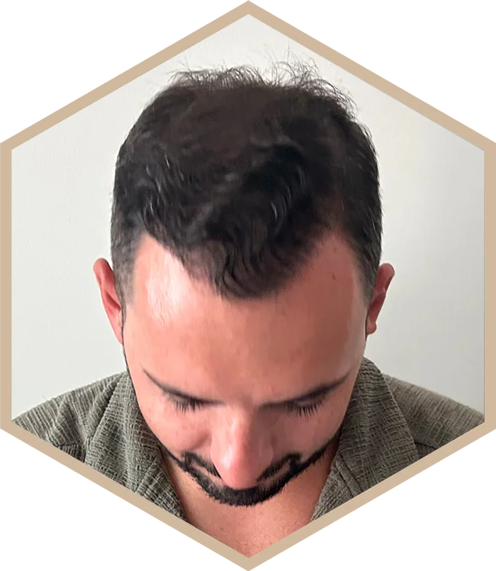 hajbeultetes-a-janos-utana-5 Hair transplantation