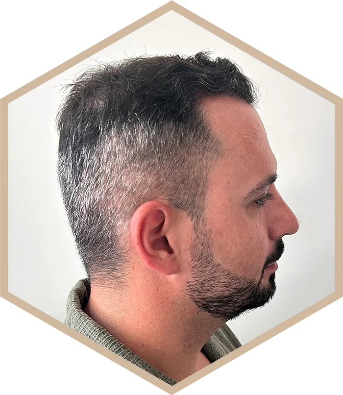 hajbeultetes-a-janos-utana-6 Hair transplantation