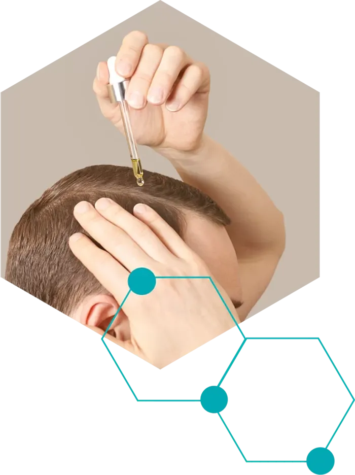 hajbeultetes-ferfiaknak-02 Die Haartransplantation
